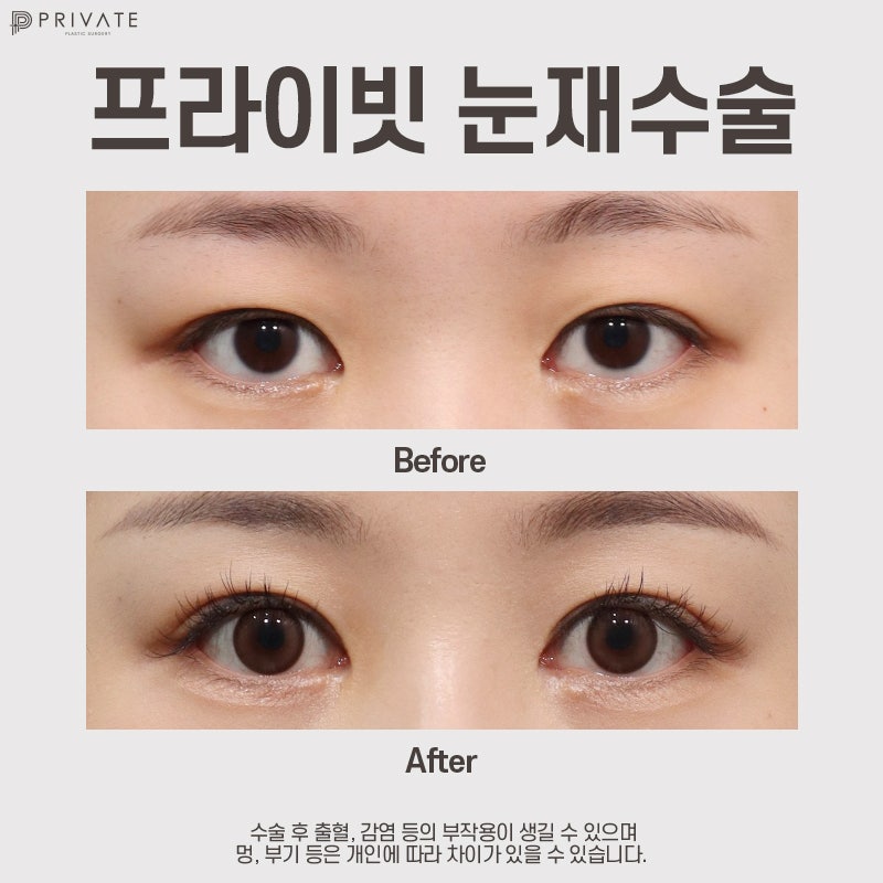 프라이빗성형외과 쌍수재수술후기 사진 8