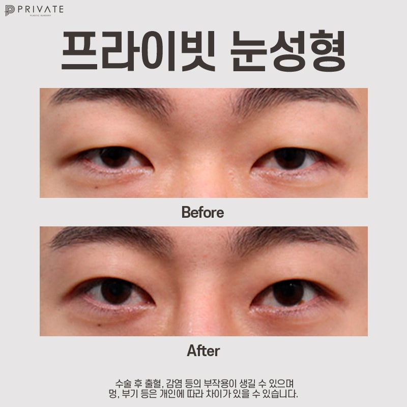 남자 눈매교정쌍수 잘하는 곳은 프라이빗성형외과 사진 9