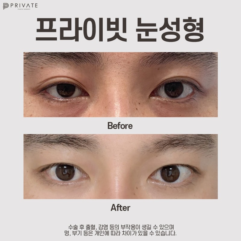 남자 눈매교정쌍수 잘하는 곳은 프라이빗성형외과 사진 8