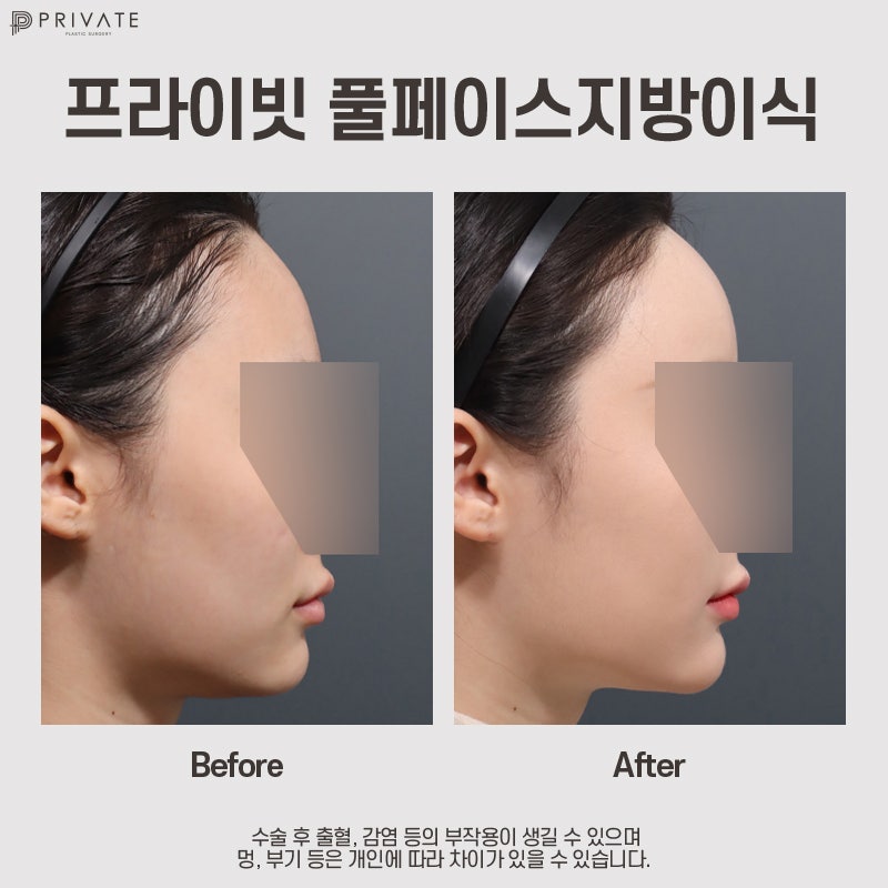 풀페이스지방이식 후기좋은병원, 프라이빗성형외과 사진 8