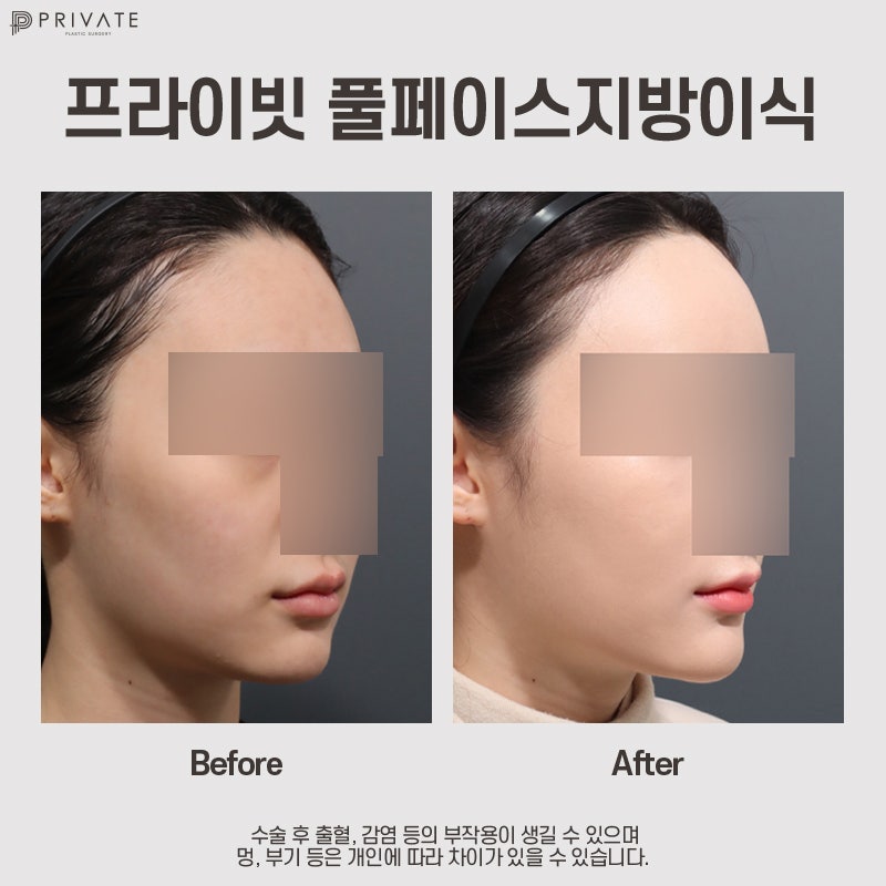 풀페이스지방이식 후기좋은병원, 프라이빗성형외과 사진 7