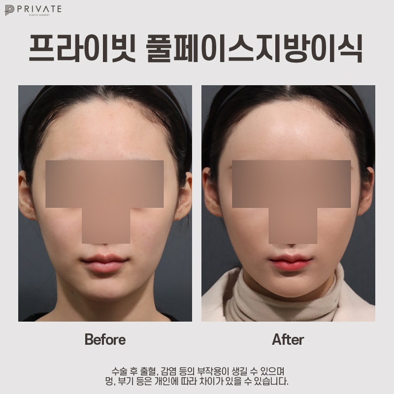 풀페이스지방이식 후기좋은병원, 프라이빗성형외과 사진 6