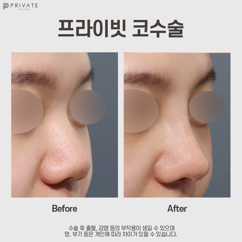 복코 성형외과는 신사 프라이빗성형외과 사진 8