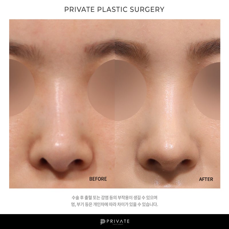 코 재수술 잘하는 병원은 신사 프라이빗성형외과 사진 7