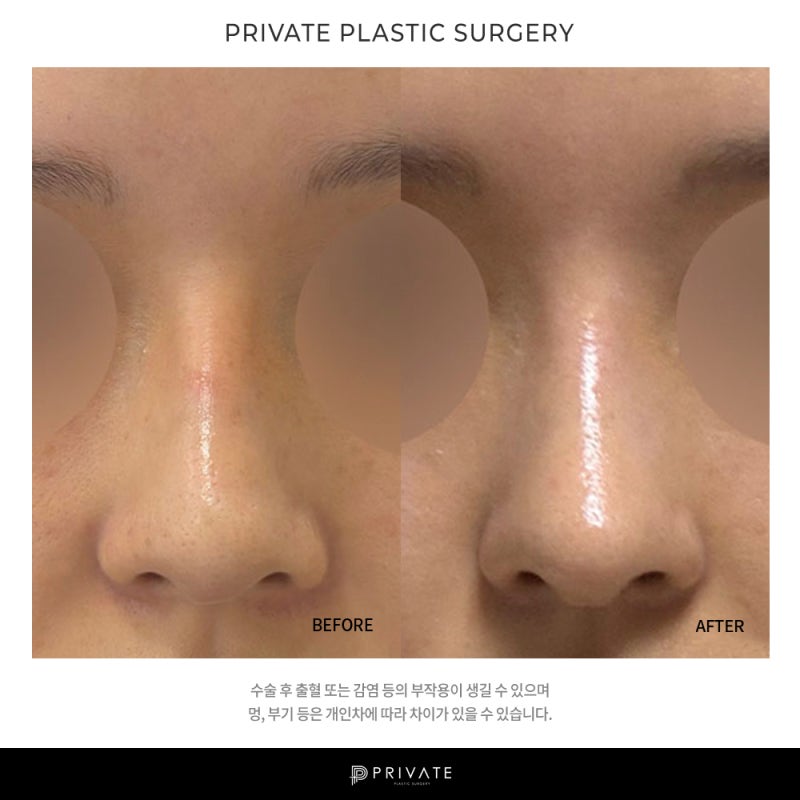 코 재수술 잘하는 병원은 신사 프라이빗성형외과 사진 8