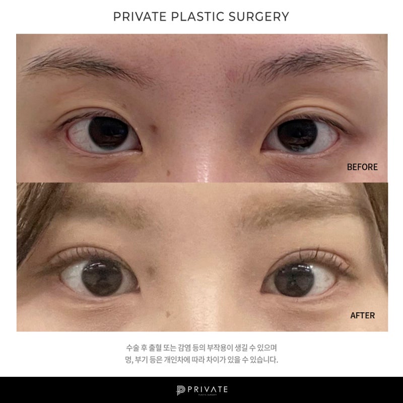 눈재수술잘하는곳 신사 프라이빗성형외과 사진 9