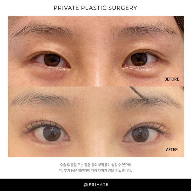 눈재수술잘하는곳 신사 프라이빗성형외과 사진 8