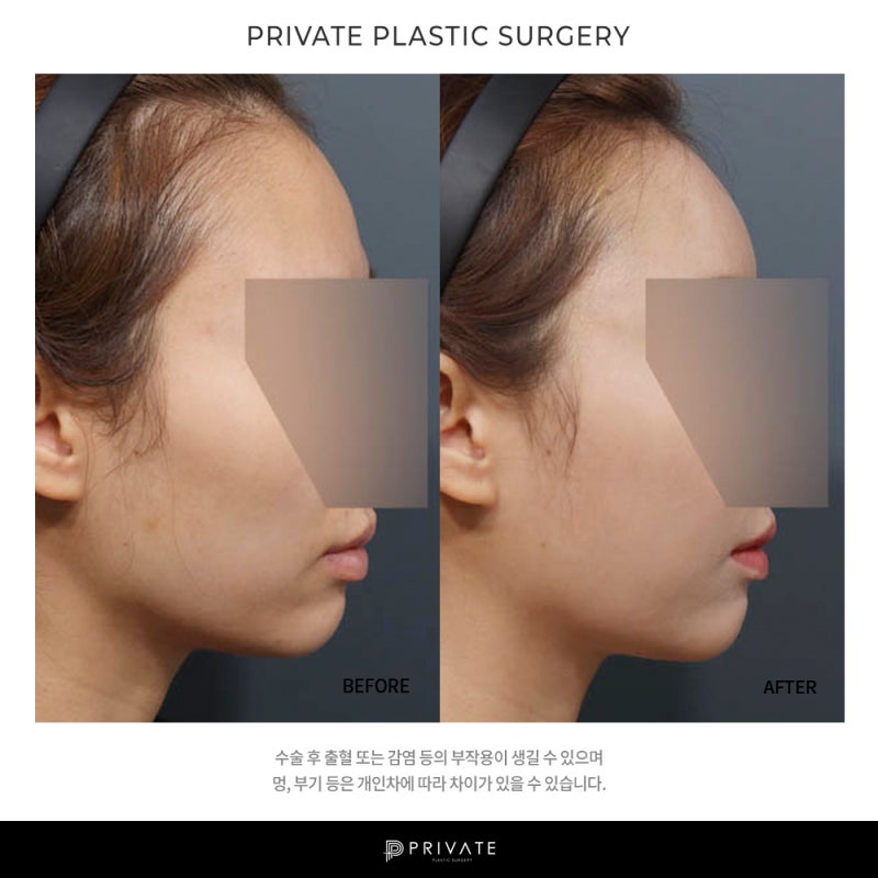 프라이빗 성형외과 지방이식수술 알아보자 사진 8