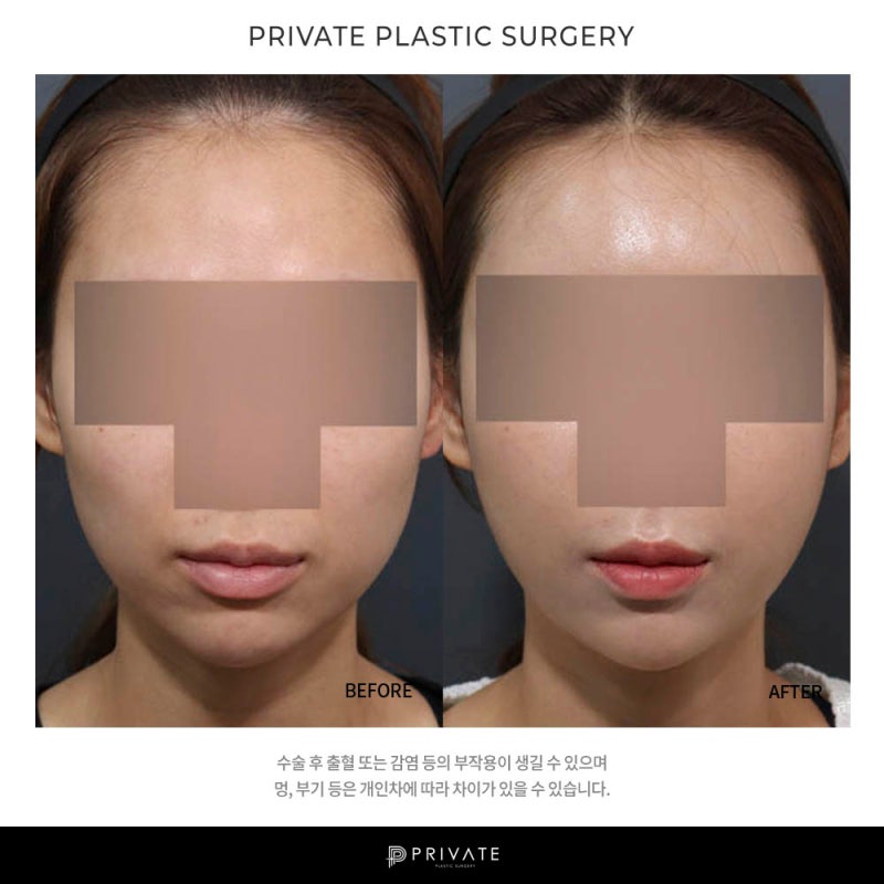 프라이빗 성형외과 지방이식수술 알아보자 사진 7