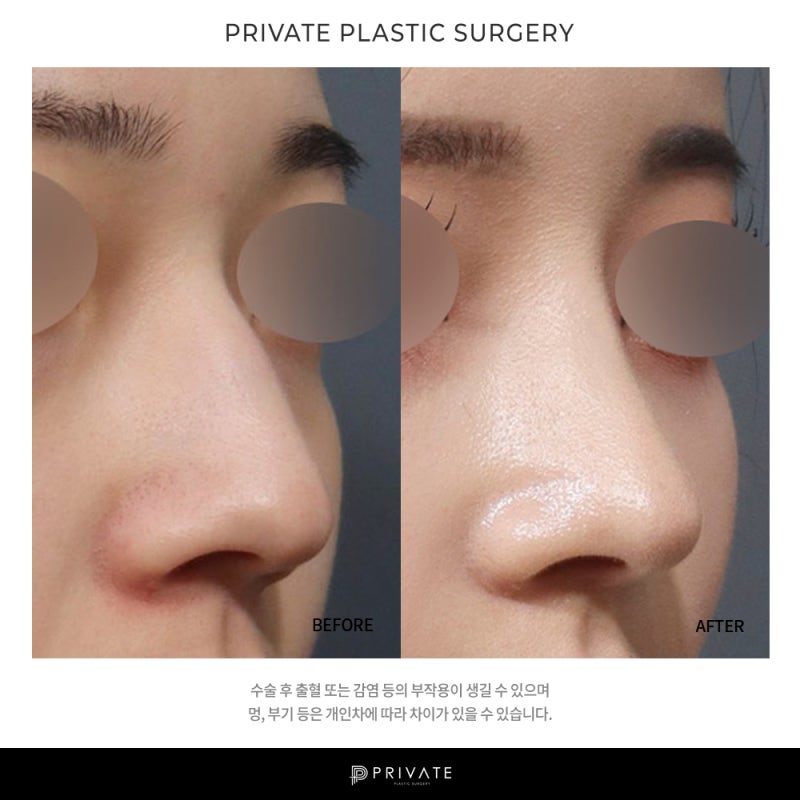 프라이빗 성형외과 코수술후기 좋은 병원 사진 8