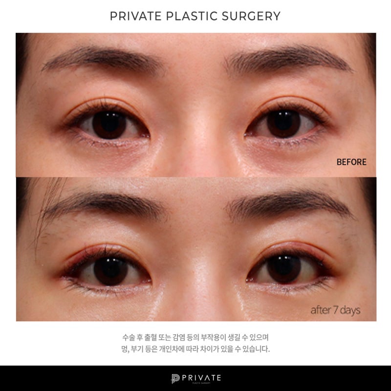 프라이빗 성형외과 뒤트임 알아보기 사진 6
