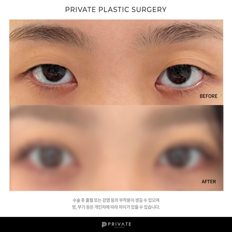 프라이빗 성형외과 쌍수 알아보자 사진 7