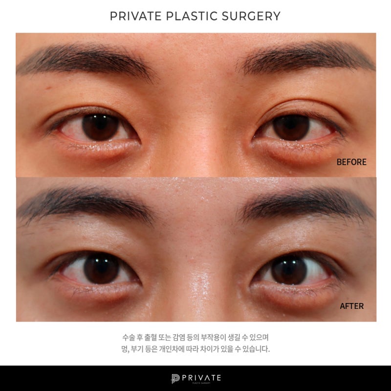 프라이빗 성형외과 남자눈매교정 알아보자 사진 9