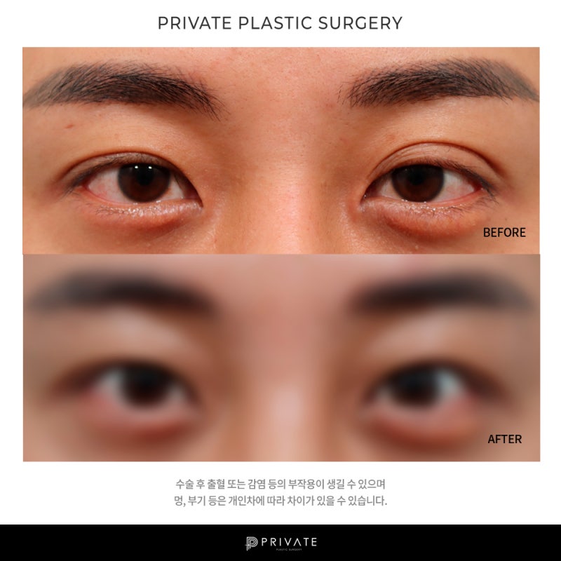 프라이빗 성형외과 남자눈매교정 알아보자 사진 8