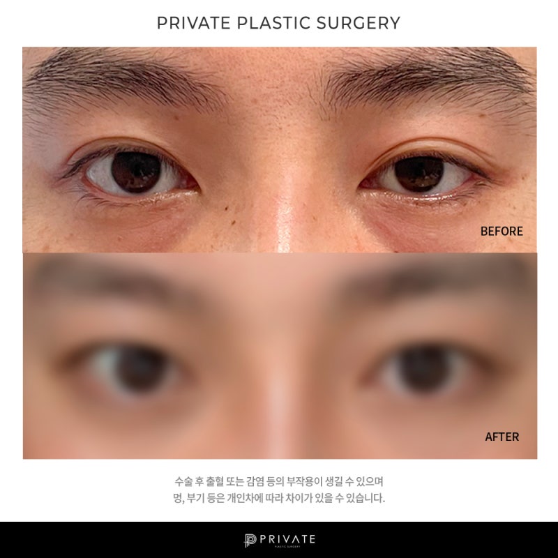 프라이빗 성형외과 남자눈매교정 알아보자 사진 10